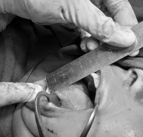 नेपाल मेडिकल कलेजले खोलिदियो निशाको मुख