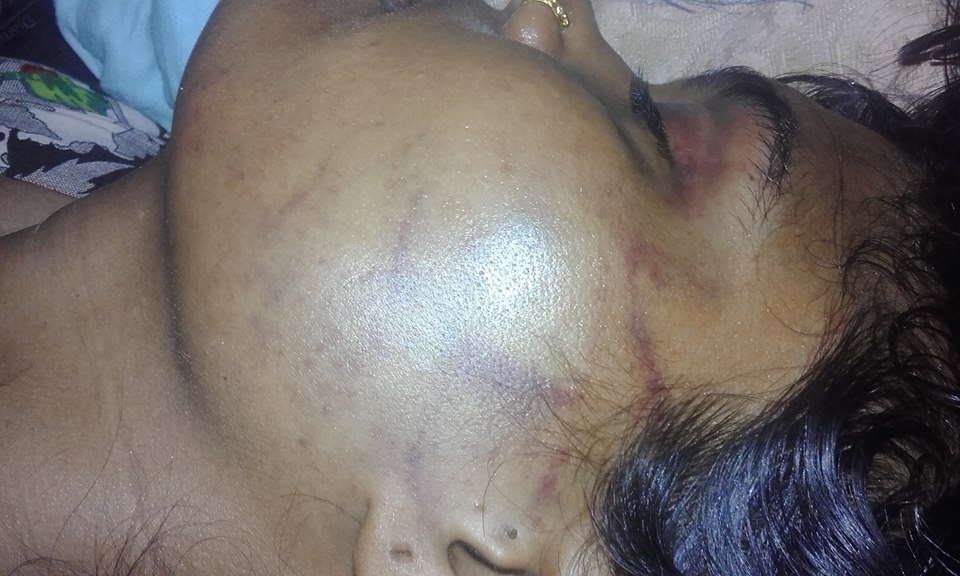 कपिलवस्तुमा दाइजोको निहुँमा महिलामाथि यातना, प्रहरीले सहयोग नगरेको पीडितको गुनासो